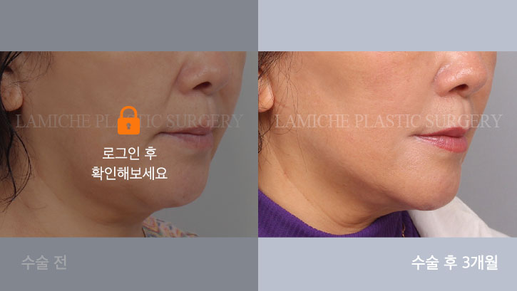sub1_35213_45도off #image_title