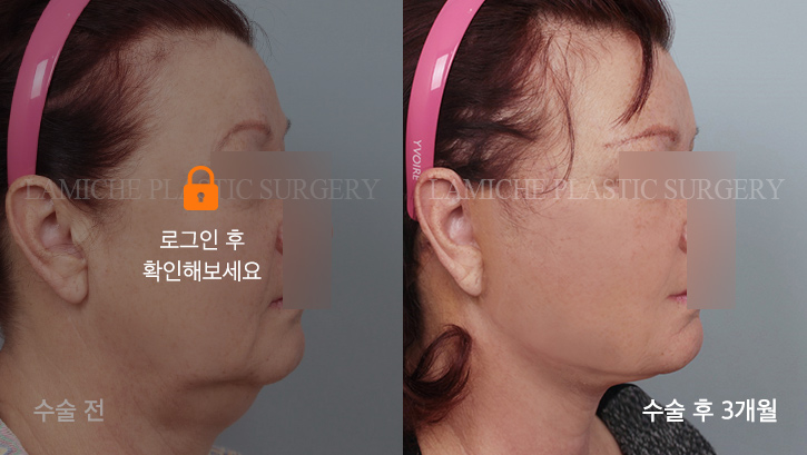 sub1_6869_측면off #image_title