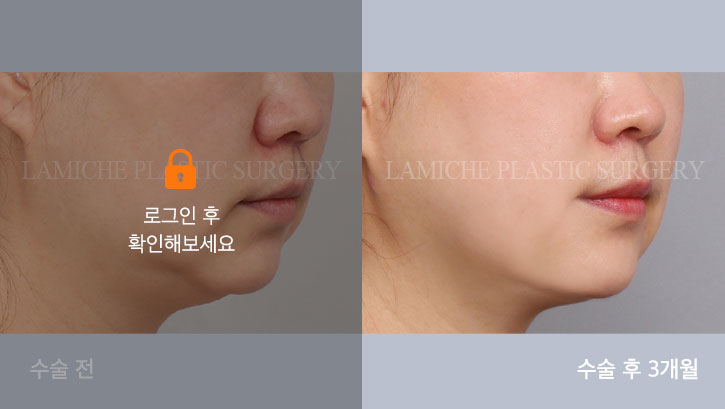 sub2_35427_45도off #image_title